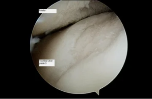 matang sa astroscope sa tuhod joint sa osteoarthritis sa 3rd degree