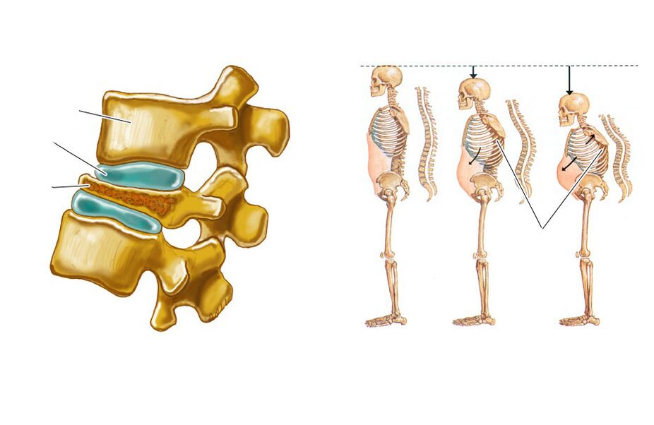 ang sagging spine mosangpot sa sakit sa likod