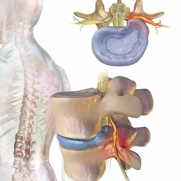 mga problema sa intervertebral disc