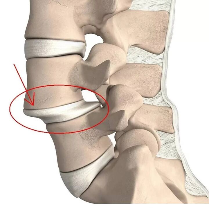 mga samad sa vertebral