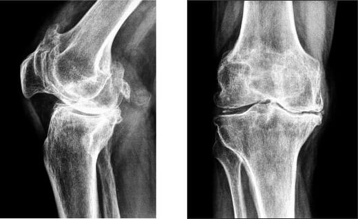 Gonarthrosis sa tuhod sa x-ray