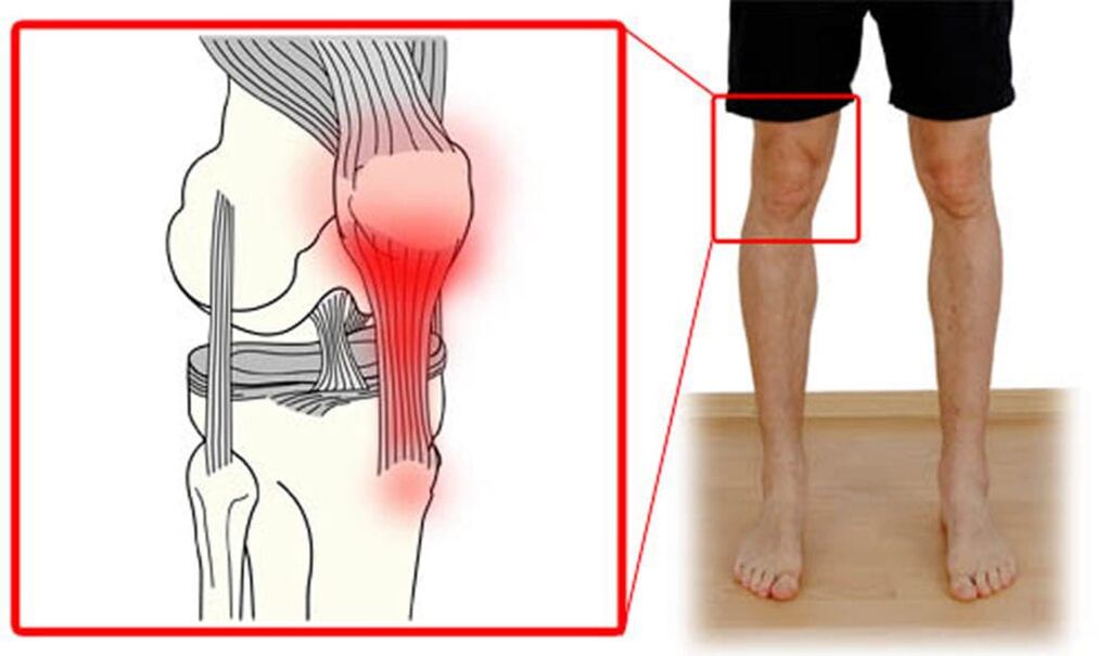 Tendinitis - panghubag sa mga ugat sa lutahan sa tuhod