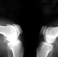 Osteoarthritis sa x-ray