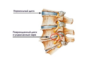 Sintomas sa utan basi malikayan an sa degenerative disc sakit