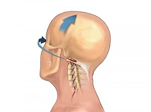 kung giunsa ang osteochondrosis sa cervical spine nagpakita sa iyang kaugalingon