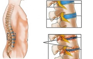 hinungdan sa osteochondrosis sa lumbar dugokan