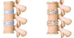 kung giunsa ang pag-ila sa presensya sa osteochondrosis sa lumbar spine