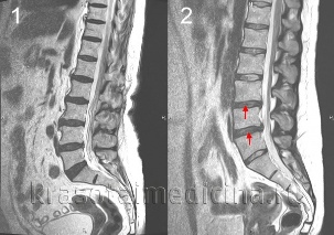 osteochondrosis sa dugokan