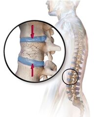 Ang Osteoporosis naghagit sa sakit sa likod sa rehiyon sa lumbar